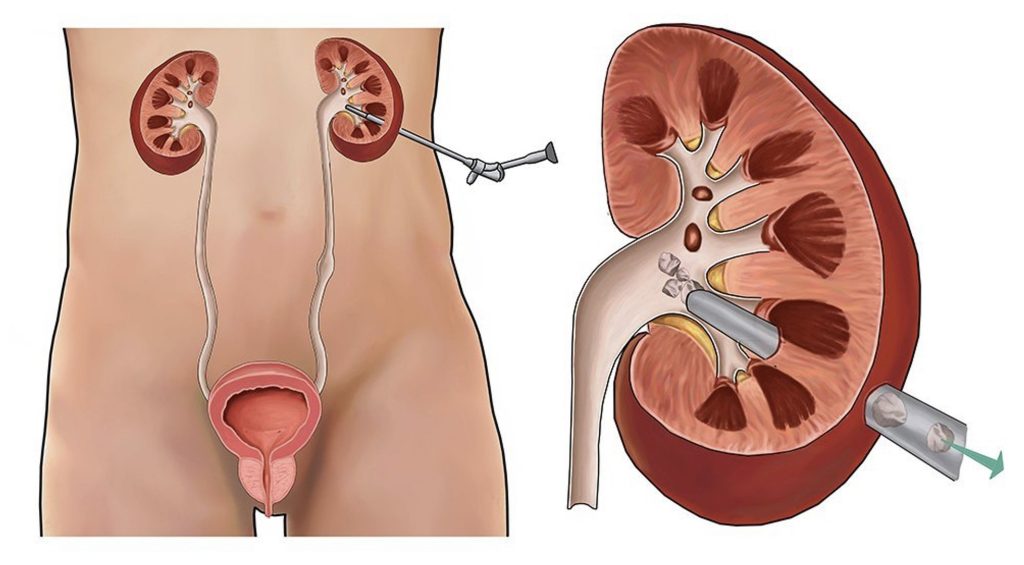 Percutaneous Nephrolithotomy (PCNL) – Surgery Procedure